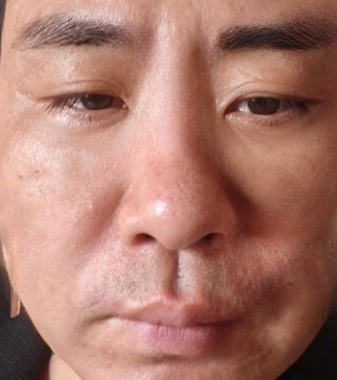 去眼袋手术
