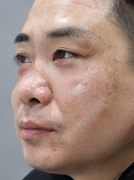 去眼袋手术