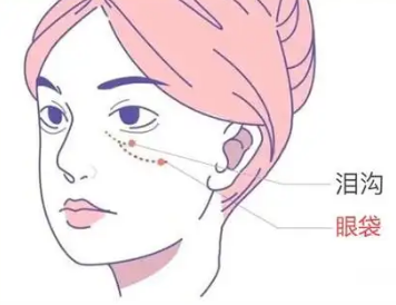 去眼袋手术