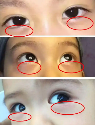 去眼袋手术