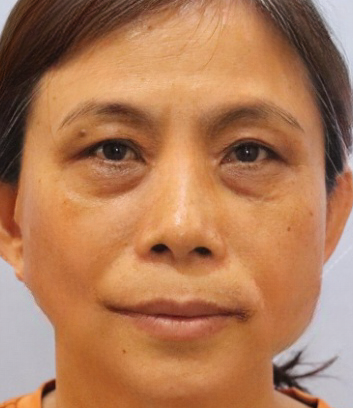 去眼袋手术