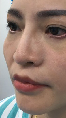 去眼袋手术