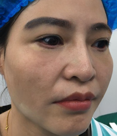 去眼袋手术