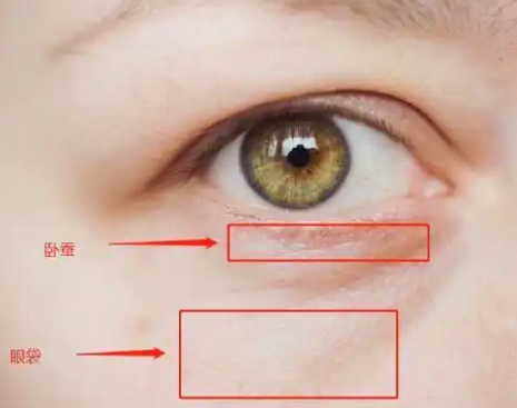 去眼袋手术
