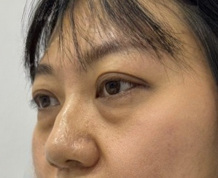 去眼袋手术