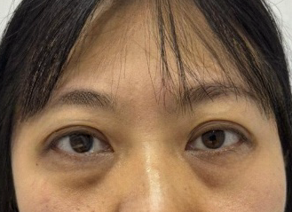 去眼袋手术