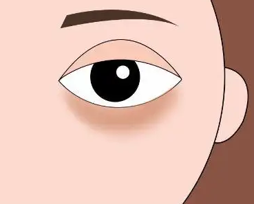 去眼袋手术