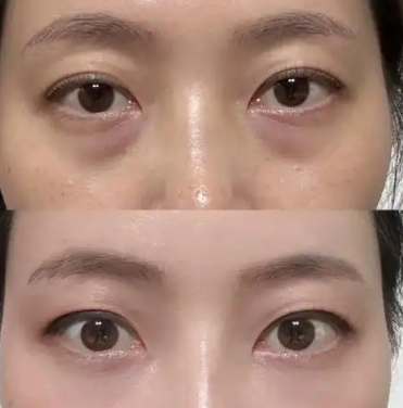 去眼袋手术