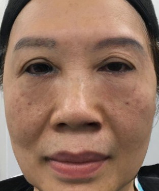 去眼袋手术