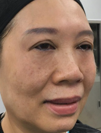 去眼袋手术
