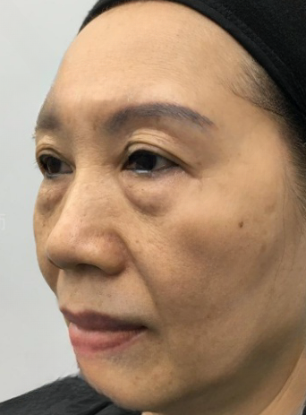 去眼袋手术