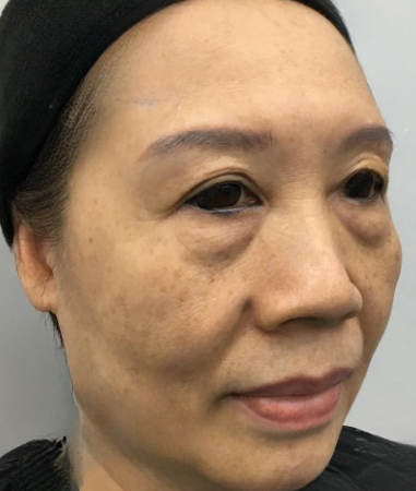 去眼袋手术