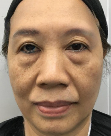 去眼袋手术