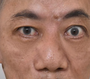 怎么消除眼袋