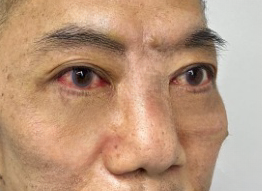 怎么消除眼袋