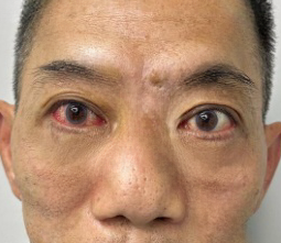 怎么消除眼袋