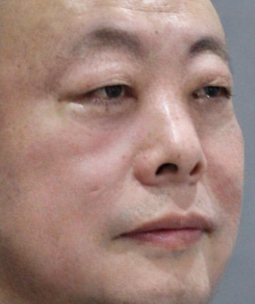 去眼袋手术