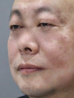 去眼袋手术