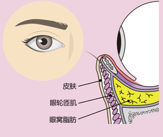 去眼袋手术
