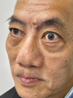 怎么消除眼袋