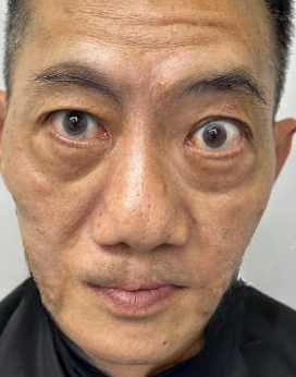 怎么消除眼袋