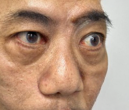 怎么消除眼袋