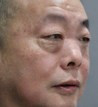 去眼袋手术