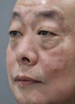 去眼袋手术