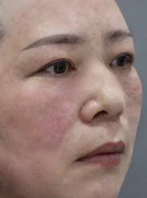 去眼袋手术