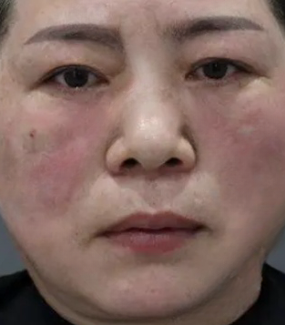 去眼袋手术