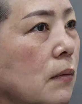 去眼袋手术
