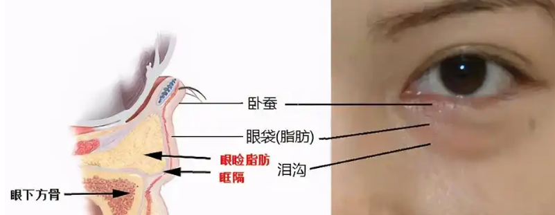 去眼袋手术