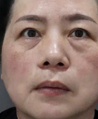 去眼袋手术