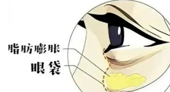 去眼袋手术