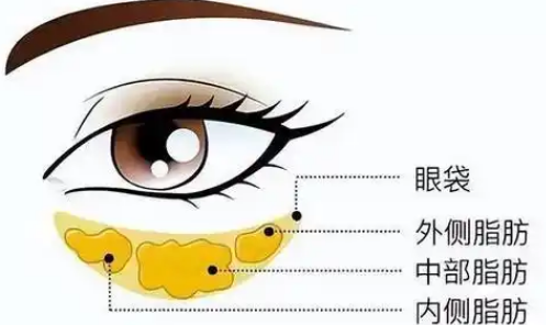 去眼袋手术