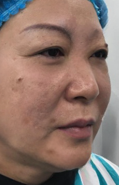 去眼袋手术
