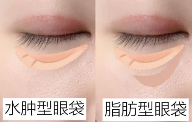 去眼袋手术