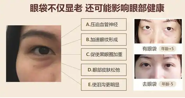 去眼袋手术