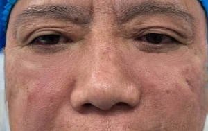 去眼袋手术