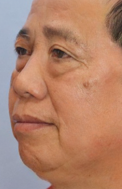 去眼袋手术