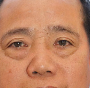去眼袋手术