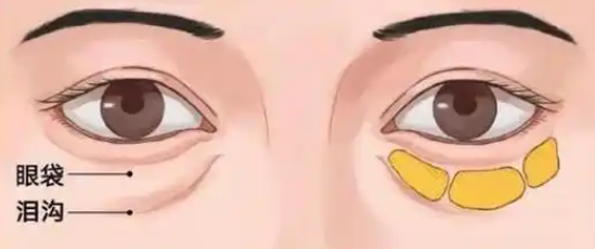 去眼袋手术
