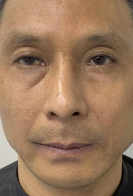 去眼袋手术