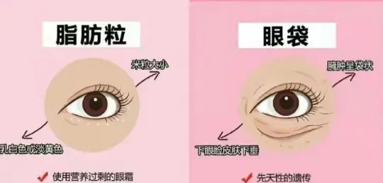 去眼袋手术