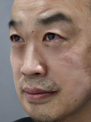 去眼袋手术