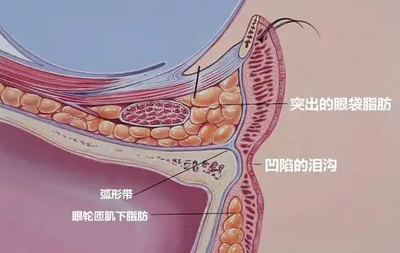 去眼袋手术