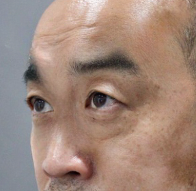 去眼袋手术