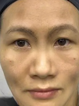去眼袋手术