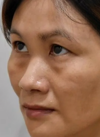 去眼袋手术