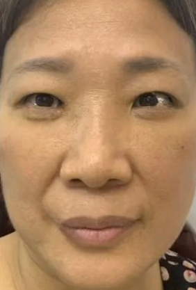 去眼袋手术
